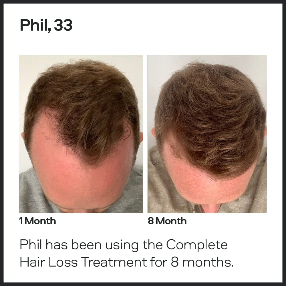 Hair Regrowth Minoxidil 5% 1 Month - for Men'S Hair Loss - Reactivates Shrunken Hair Follicles - Unique Precision Applicator System